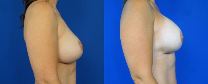 Before & After Breast Implant Exchange - NO LIFT  Case 201 View #5 View in Fort Worth & Arlington, Texas