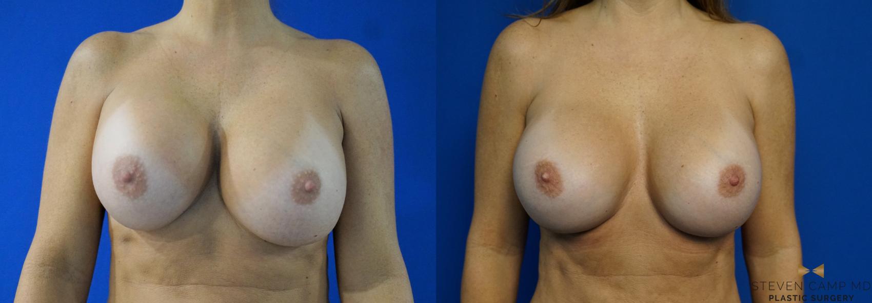 Breast Implant Exchange  Before & After Photo | Fort Worth, Texas | Steven Camp MD Plastic Surgery