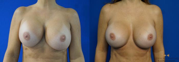 Before & After Breast Implant Exchange - NO LIFT  Case 288 View #1 View in Fort Worth & Arlington, Texas