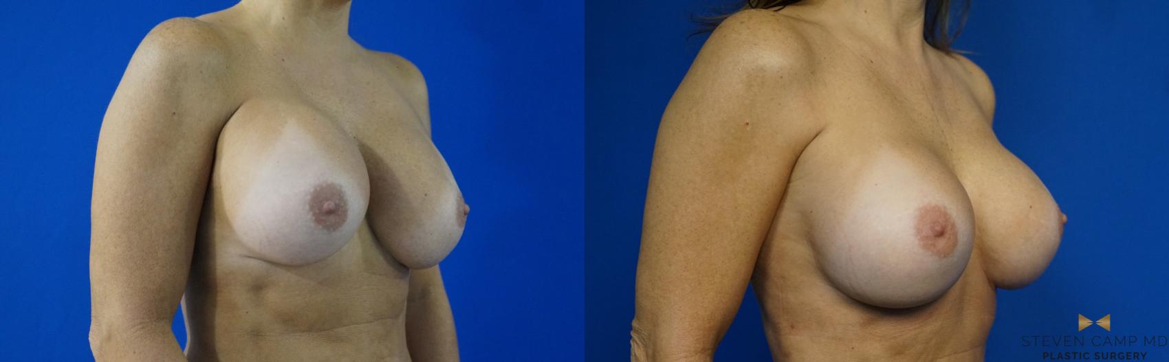 Before & After Breast Implant Exchange - NO LIFT  Case 288 View #2 View in Fort Worth & Arlington, Texas