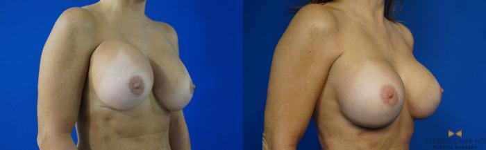 Before & After Breast Implant Exchange - NO LIFT  Case 288 View #2 View in Fort Worth, Texas