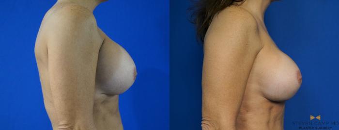 Before & After Breast Implant Exchange - NO LIFT  Case 288 View #3 View in Fort Worth & Arlington, Texas
