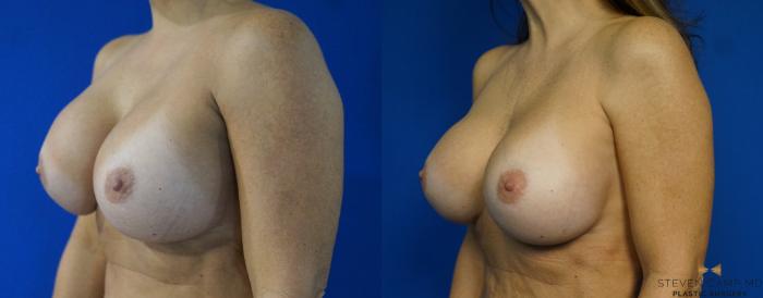 Before & After Breast Implant Exchange - NO LIFT  Case 288 View #4 View in Fort Worth & Arlington, Texas