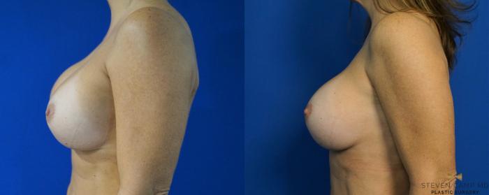 Before & After Breast Implant Exchange - NO LIFT  Case 288 View #5 View in Fort Worth, Texas