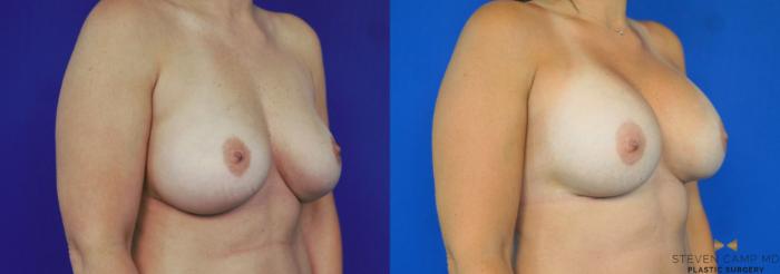 Before & After Breast Implant Exchange - NO LIFT  Case 290 View #2 View in Fort Worth & Arlington, Texas