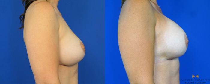 Before & After Breast Implant Exchange - NO LIFT  Case 290 View #3 View in Fort Worth & Arlington, Texas