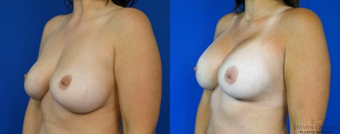 Before & After Breast Implant Exchange - NO LIFT  Case 290 View #4 View in Fort Worth & Arlington, Texas