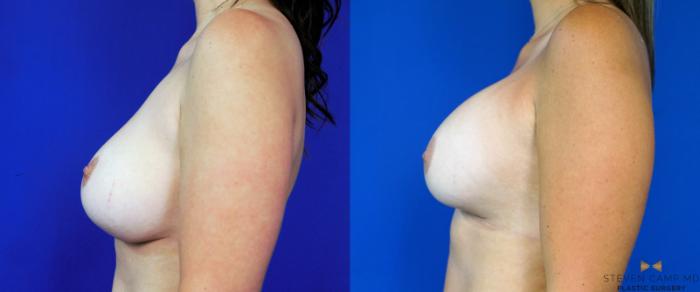 Before & After Breast Implant Exchange - NO LIFT  Case 290 View #5 View in Fort Worth & Arlington, Texas