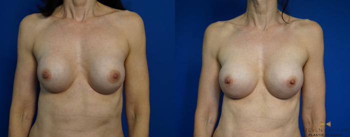 Before & After Breast Implant Exchange - NO LIFT  Case 297 View #1 View in Fort Worth & Arlington, Texas