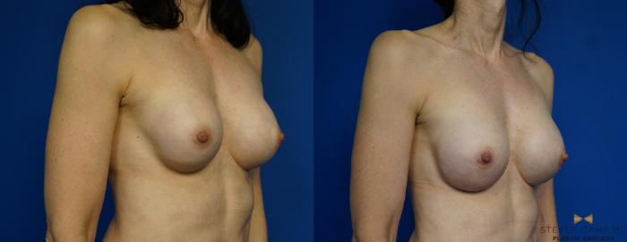 Before & After Breast Implant Exchange - NO LIFT  Case 297 View #2 View in Fort Worth & Arlington, Texas