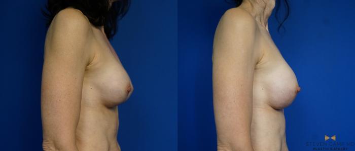Before & After Breast Implant Exchange - NO LIFT  Case 297 View #3 View in Fort Worth & Arlington, Texas