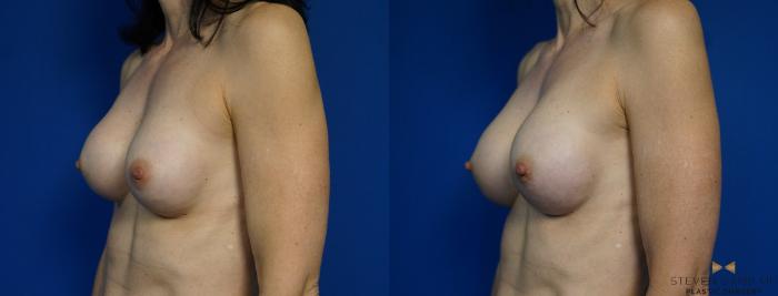 Before & After Breast Implant Exchange - NO LIFT  Case 297 View #4 View in Fort Worth & Arlington, Texas