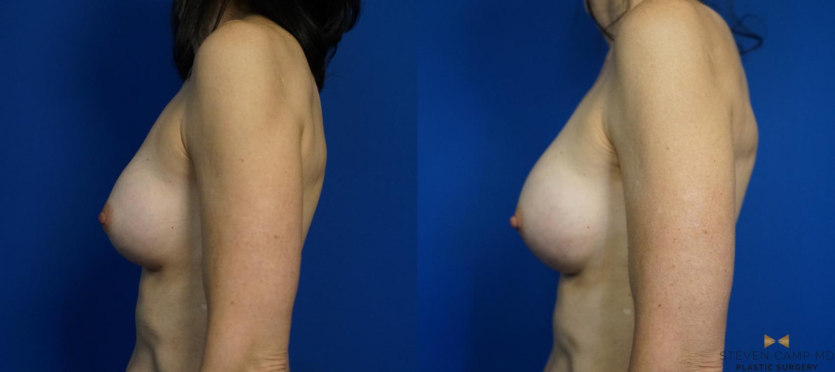 Before & After Breast Implant Exchange - NO LIFT  Case 297 View #5 View in Fort Worth & Arlington, Texas