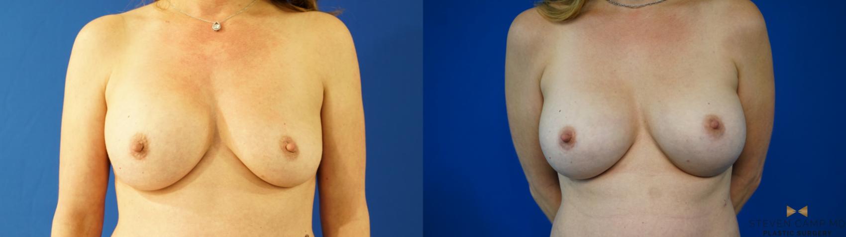 Before & After Breast Implant Exchange - NO LIFT  Case 354 Front View in Fort Worth & Arlington, Texas