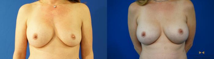 Before & After Breast Implant Exchange - NO LIFT  Case 354 Front View in Fort Worth & Arlington, Texas
