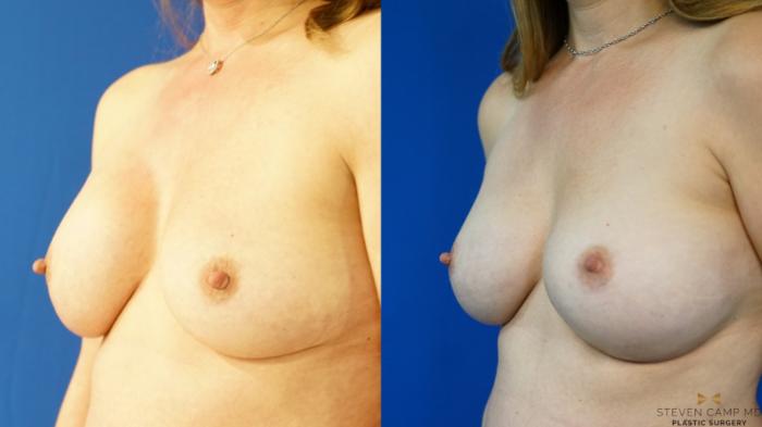Before & After Breast Implant Exchange - NO LIFT  Case 354 Left Oblique View in Fort Worth & Arlington, Texas