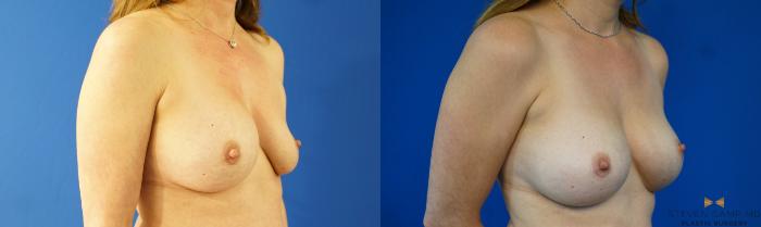 Before & After Breast Implant Exchange - NO LIFT  Case 354 Right Oblique View in Fort Worth & Arlington, Texas