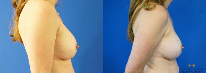 Before & After Breast Implant Exchange - NO LIFT  Case 354 Right Side View in Fort Worth & Arlington, Texas