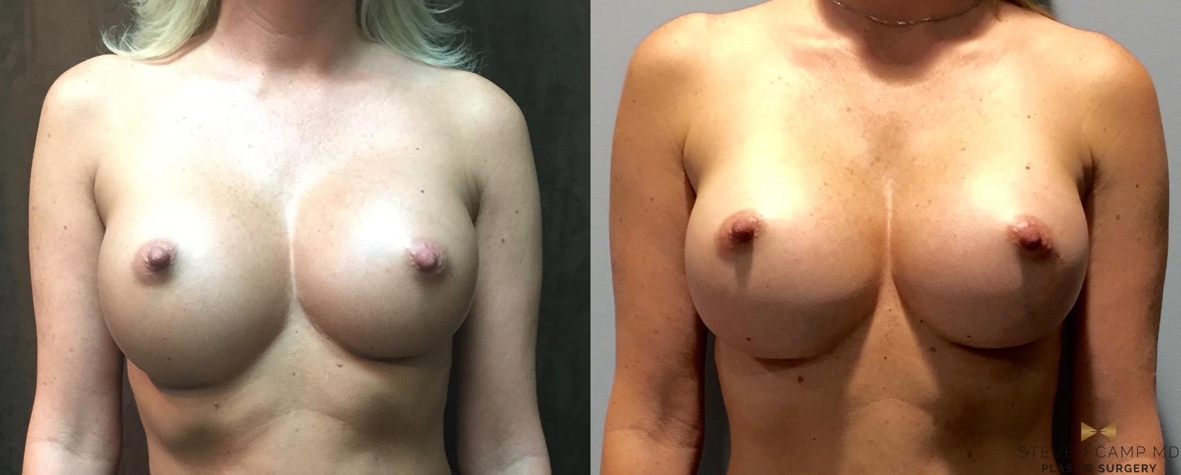 Before & After Breast Implant Exchange  Case 74 View #1 View in Fort Worth, Texas