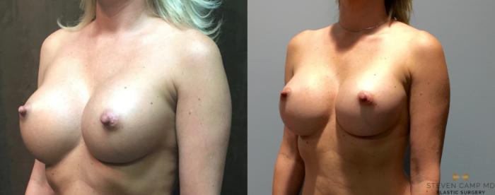 Before & After Breast Implant Exchange - NO LIFT  Case 74 View #2 View in Fort Worth & Arlington, Texas