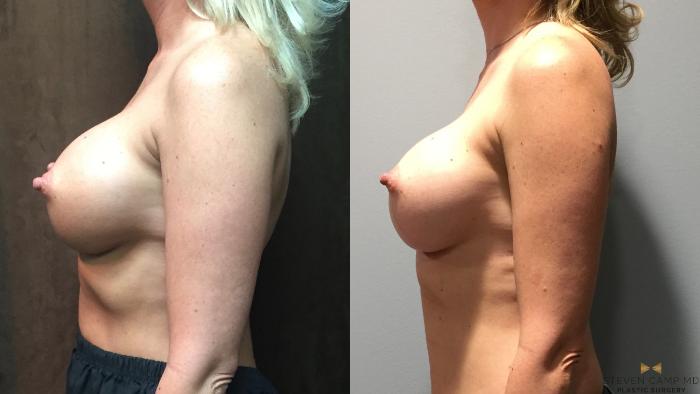 Before & After Breast Implant Exchange - NO LIFT  Case 74 View #3 View in Fort Worth, Texas