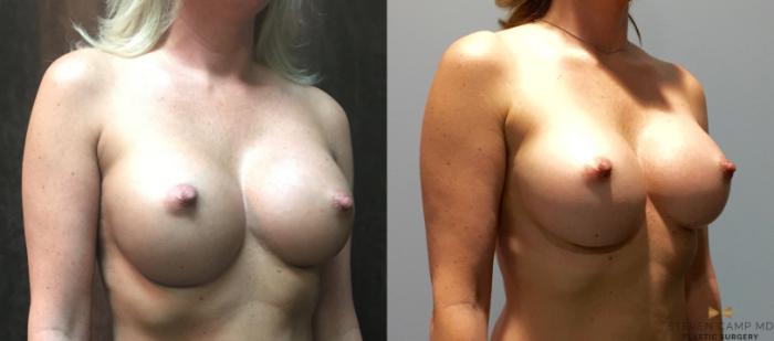 Before & After Breast Implant Exchange - NO LIFT  Case 74 View #4 View in Fort Worth, Texas