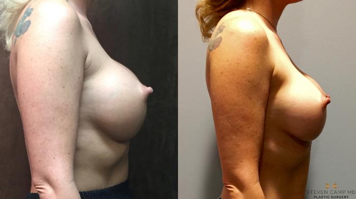 Before & After Breast Implant Exchange - NO LIFT  Case 74 View #5 View in Fort Worth, Texas