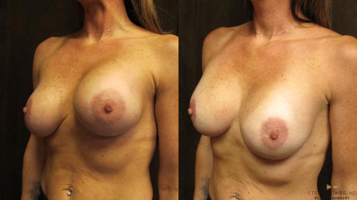Before & After Breast Implant Exchange - NO LIFT  Case 95 View #2 View in Fort Worth & Arlington, Texas