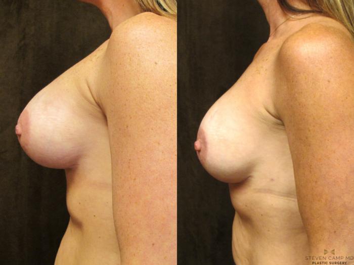 Before & After Breast Implant Exchange - NO LIFT  Case 95 View #3 View in Fort Worth & Arlington, Texas
