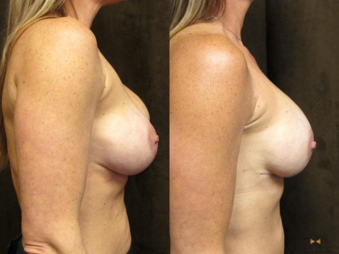 Before & After Breast Implant Exchange - NO LIFT  Case 95 View #4 View in Fort Worth & Arlington, Texas
