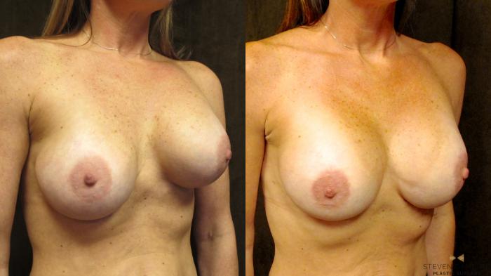 Before & After Breast Implant Exchange - NO LIFT  Case 95 View #5 View in Fort Worth & Arlington, Texas