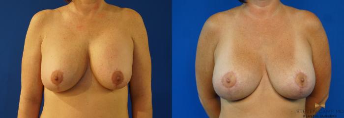 Before & After Breast Lift (Breast Mastopexy with Implants) Case 159 View #1 View in Fort Worth & Arlington, Texas