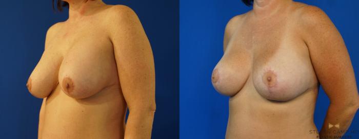 Before & After Breast Lift (Breast Mastopexy with Implants) Case 159 View #2 View in Fort Worth & Arlington, Texas