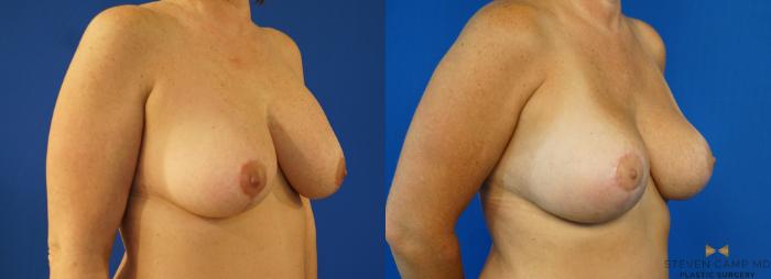Before & After Breast Implant Exchange (Breast Revision) Case 159 View #4 View in Fort Worth & Arlington, Texas
