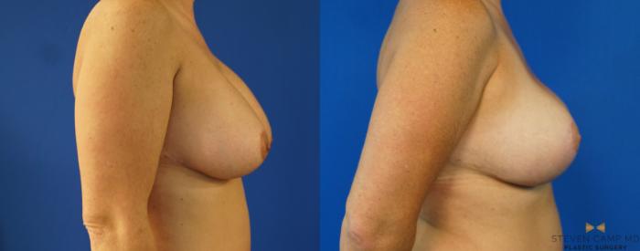 Before & After Breast Lift (Breast Mastopexy with Implants) Case 159 View #5 View in Fort Worth & Arlington, Texas