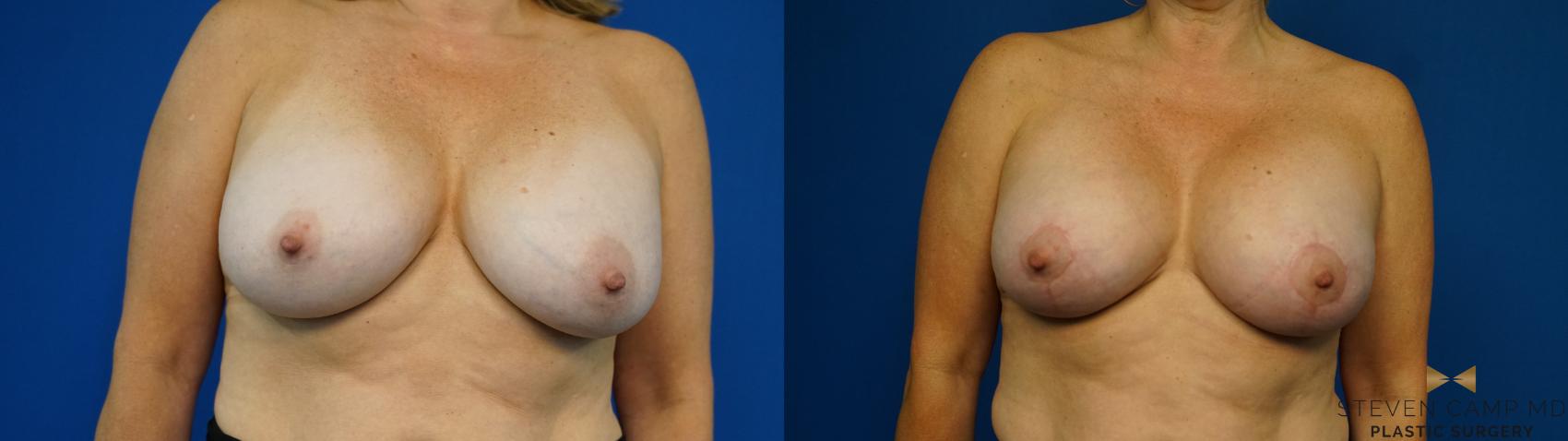 Before & After Breast Implant Exchange (Breast Revision) Case 314 Front View in Fort Worth & Arlington, Texas