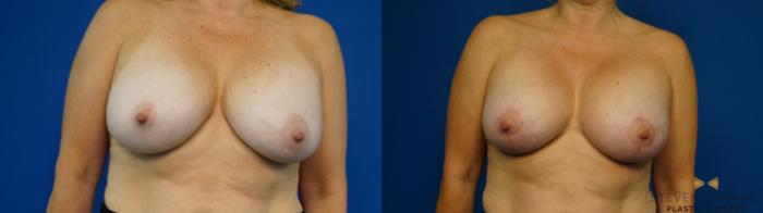 Before & After Breast Implant Exchange (Breast Revision) Case 314 Front View in Fort Worth & Arlington, Texas