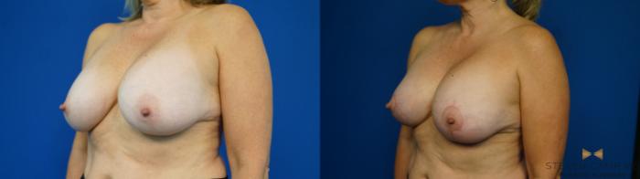Before & After Breast Implant Exchange (Breast Revision) Case 314 Left Oblique View in Fort Worth & Arlington, Texas