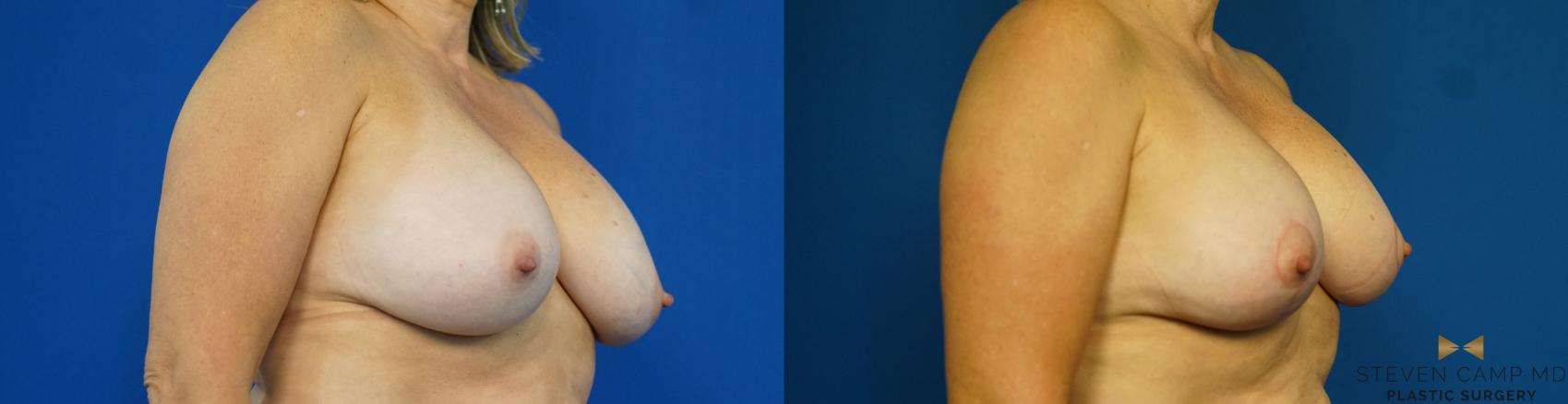 Before & After Breast Implant Exchange (Breast Revision) Case 314 Right Oblique View in Fort Worth & Arlington, Texas