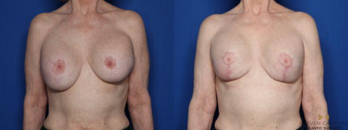 Before & After Breast Implant Exchange (Breast Revision) Case 433 Front View in Fort Worth & Arlington, Texas