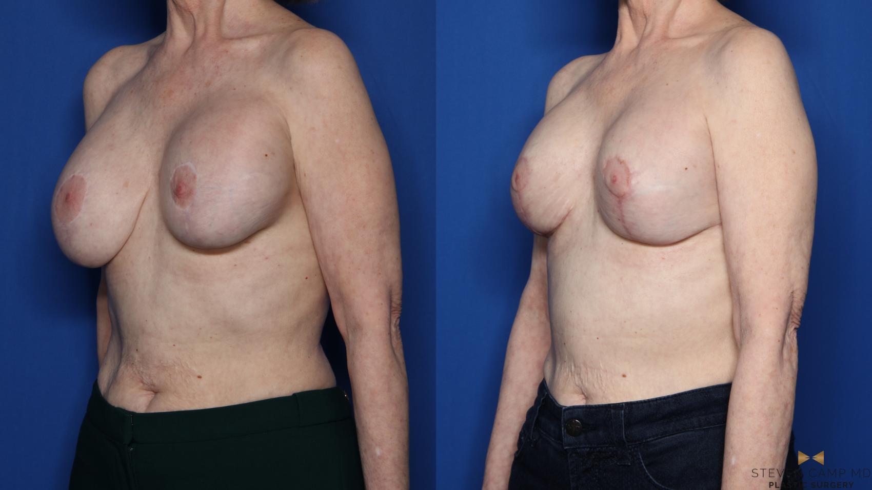 Before & After Breast Implant Exchange (Breast Revision) Case 433 Left Oblique View in Fort Worth & Arlington, Texas