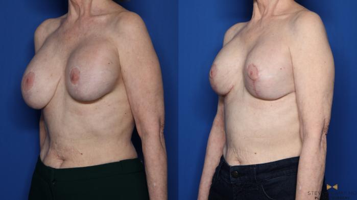 Before & After Breast Lift (Breast Mastopexy with Implants) Case 433 Left Oblique View in Fort Worth & Arlington, Texas