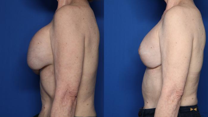 Before & After Breast Lift (Breast Mastopexy with Implants) Case 433 Left Side View in Fort Worth & Arlington, Texas