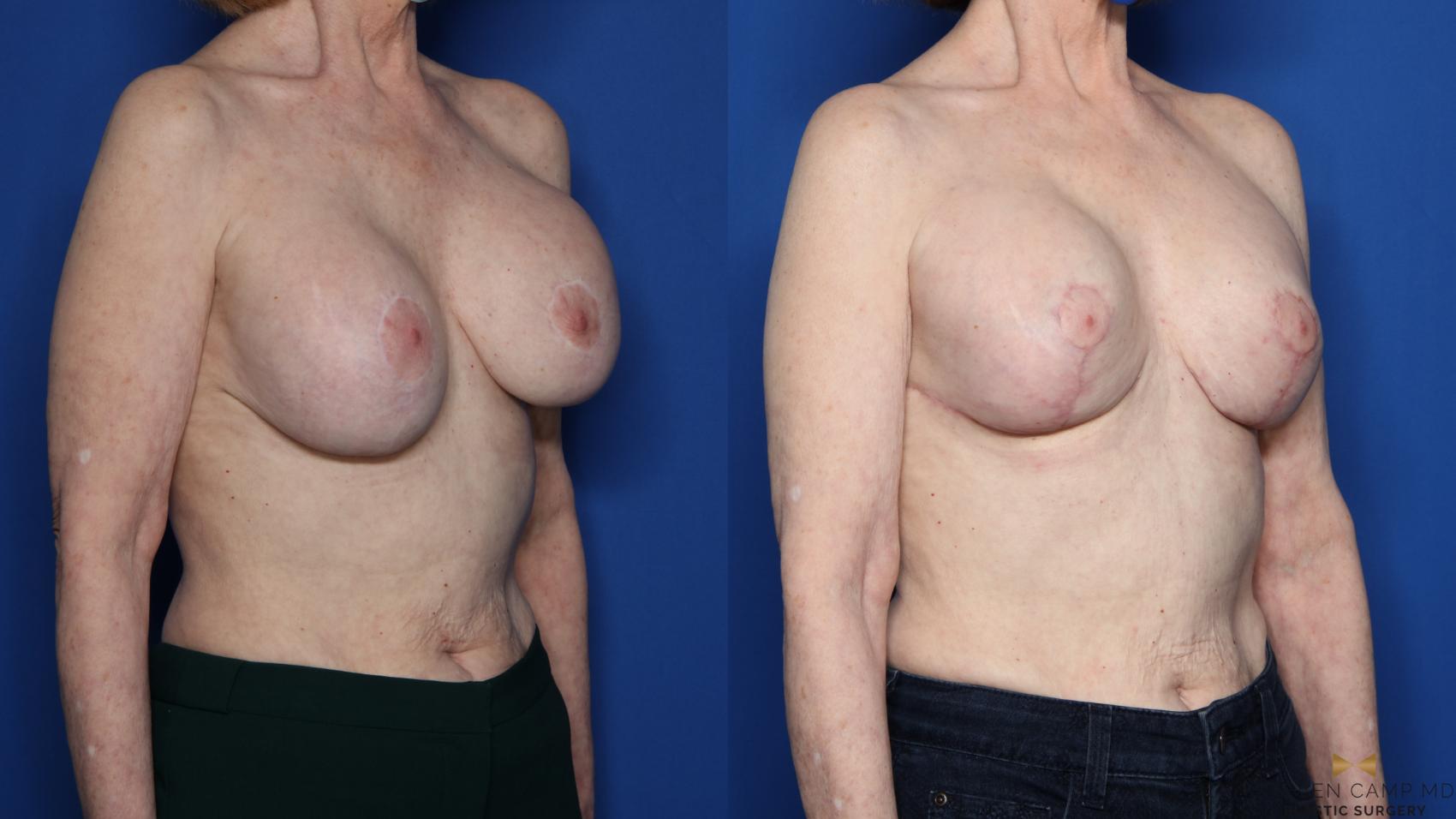 Before & After Breast Implant Exchange (Breast Revision) Case 433 Right Oblique View in Fort Worth & Arlington, Texas