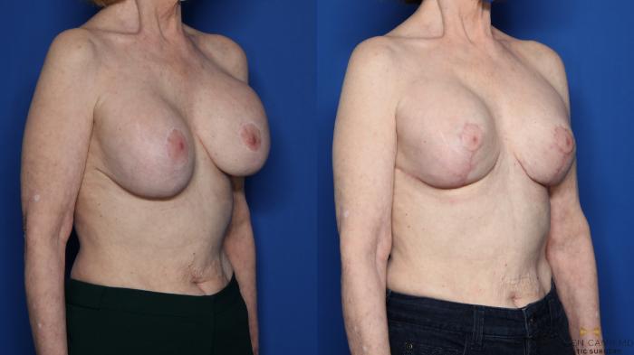 Before & After Breast Lift (Breast Mastopexy with Implants) Case 433 Right Oblique View in Fort Worth & Arlington, Texas