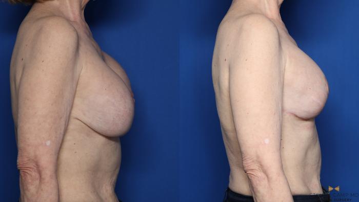 Before & After Breast Lift (Breast Mastopexy with Implants) Case 433 Right Side View in Fort Worth & Arlington, Texas