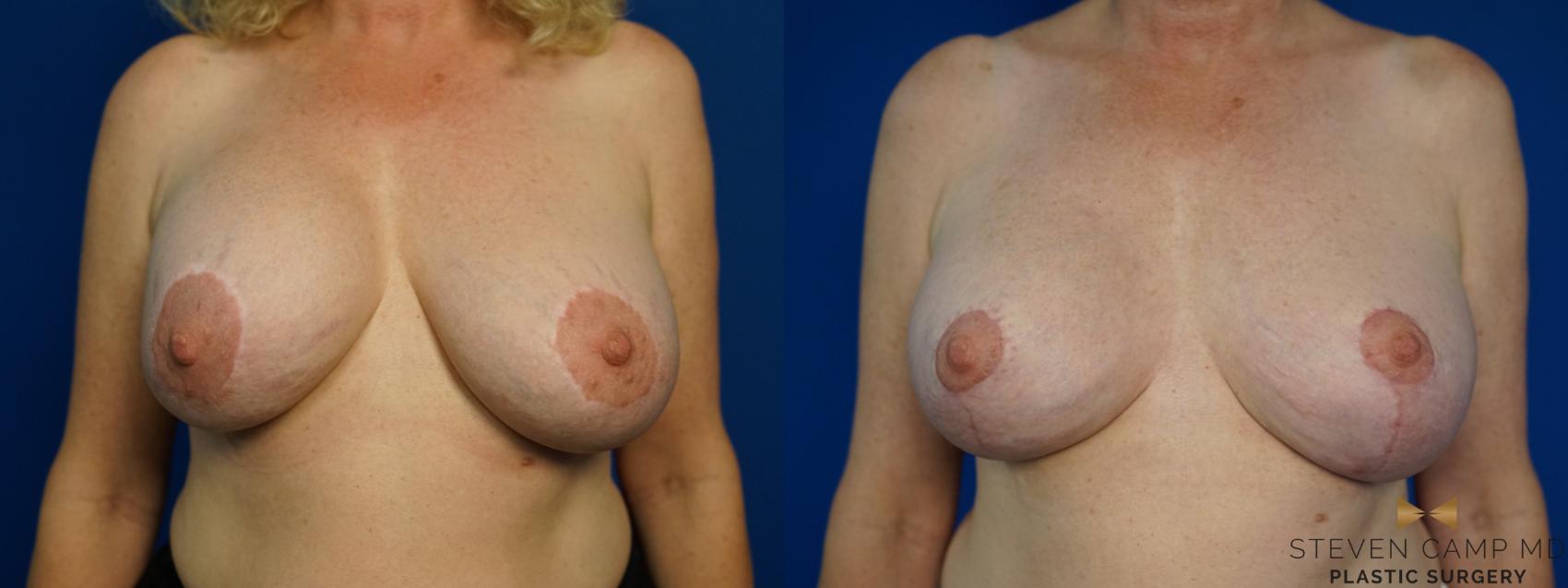 Before & After Breast Implant Exchange (Breast Revision) Case 462 Front View in Fort Worth & Arlington, Texas