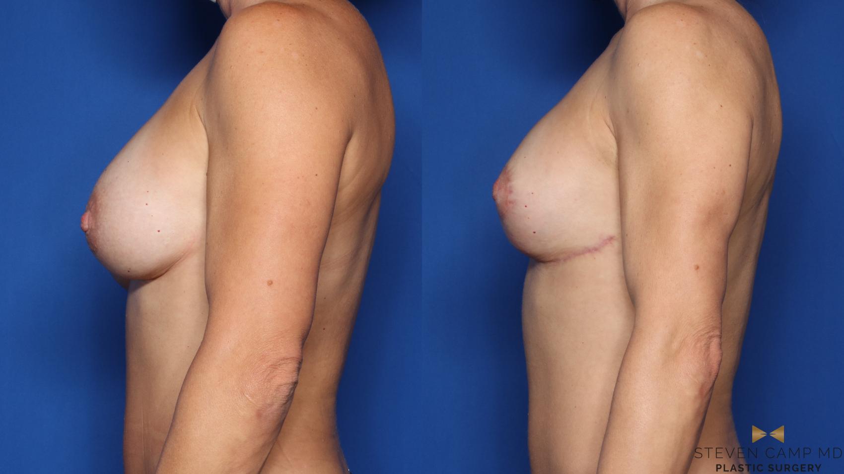 Before & After Breast Implant Exchange (Breast Revision) Case 463 Left Side View in Fort Worth & Arlington, Texas