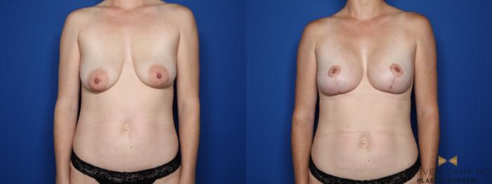 Before & After Breast Implant Exchange (Breast Revision) Case 541 Front View in Fort Worth & Arlington, Texas