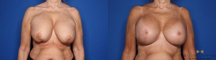 Before & After Breast Implant Exchange (Breast Revision) Case 553 Front View in Fort Worth & Arlington, Texas